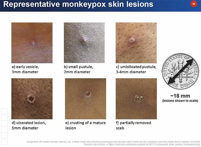Monkeypox skin lesions