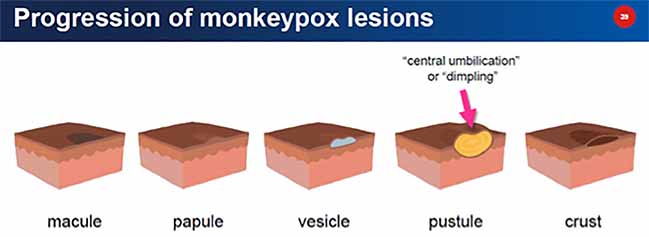 Progression on monkeypox