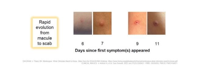 rapid evolution from macule to scab