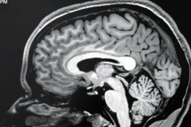 MRI of a brain