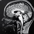 A brain image taken using magnetic resonance imaging (MRI)